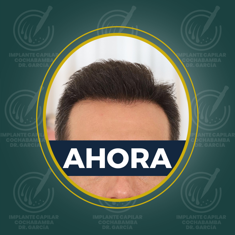 undefined - Después