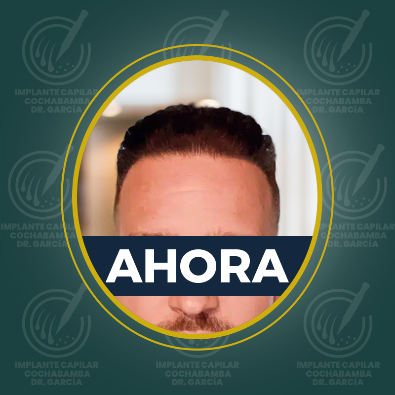 undefined - Después