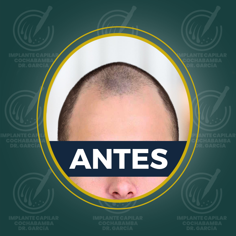 undefined - Antes