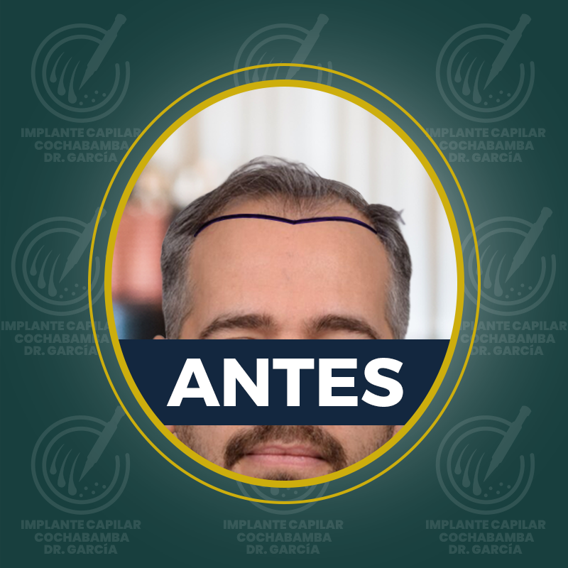 undefined - Antes
