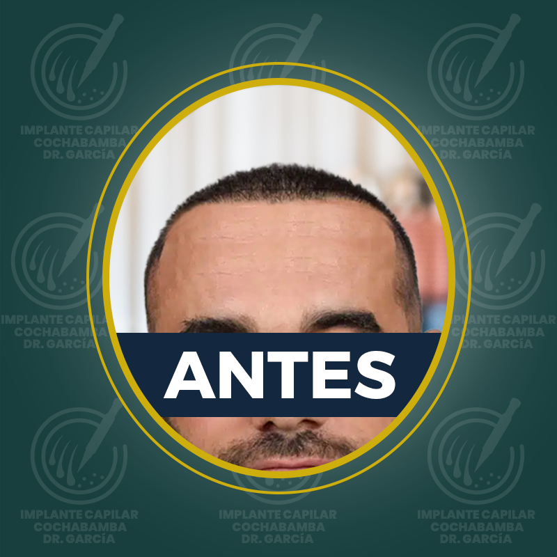 undefined - Antes