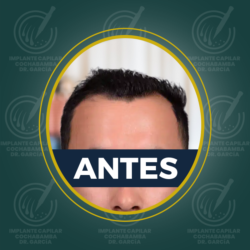 undefined - Antes