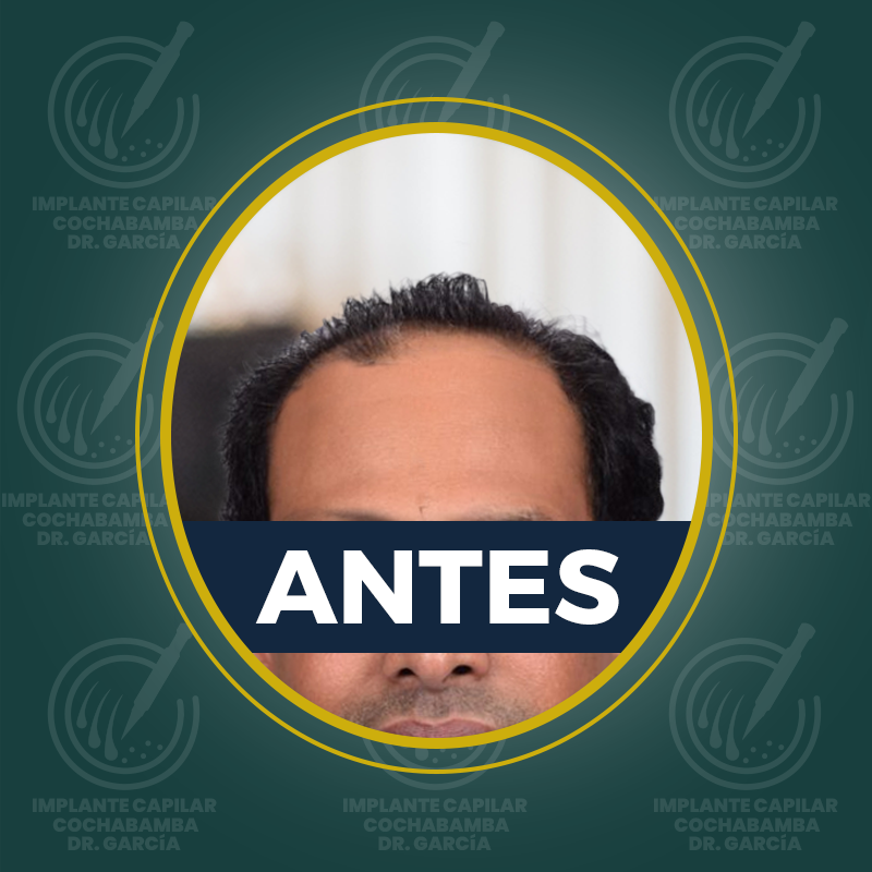 undefined - Antes