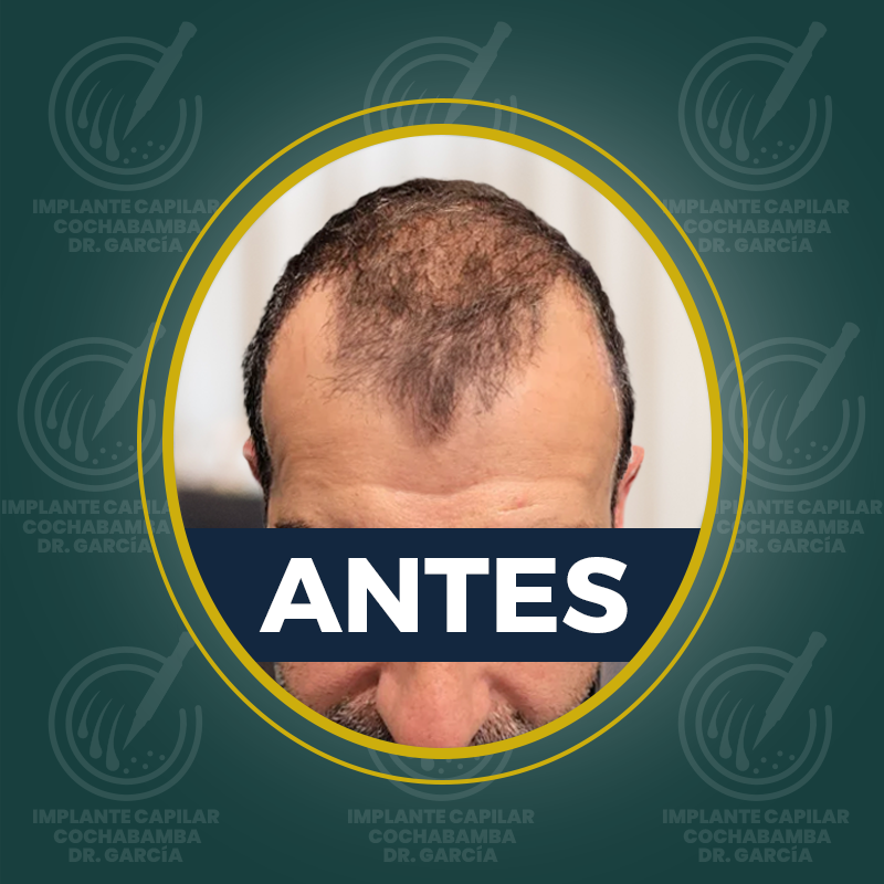 undefined - Antes