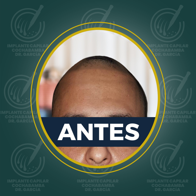 undefined - Antes