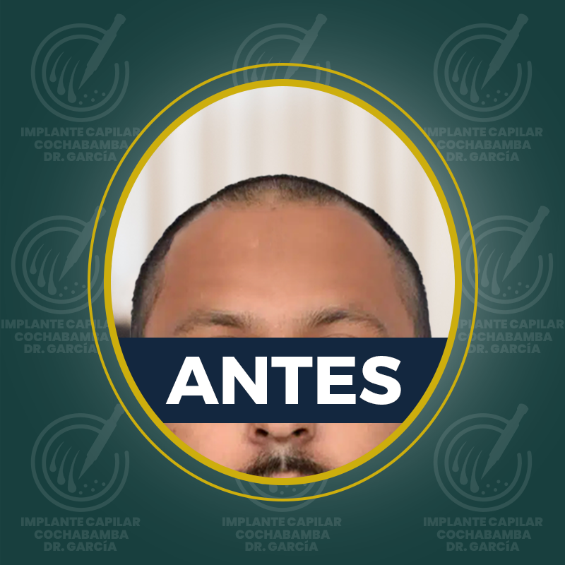undefined - Antes