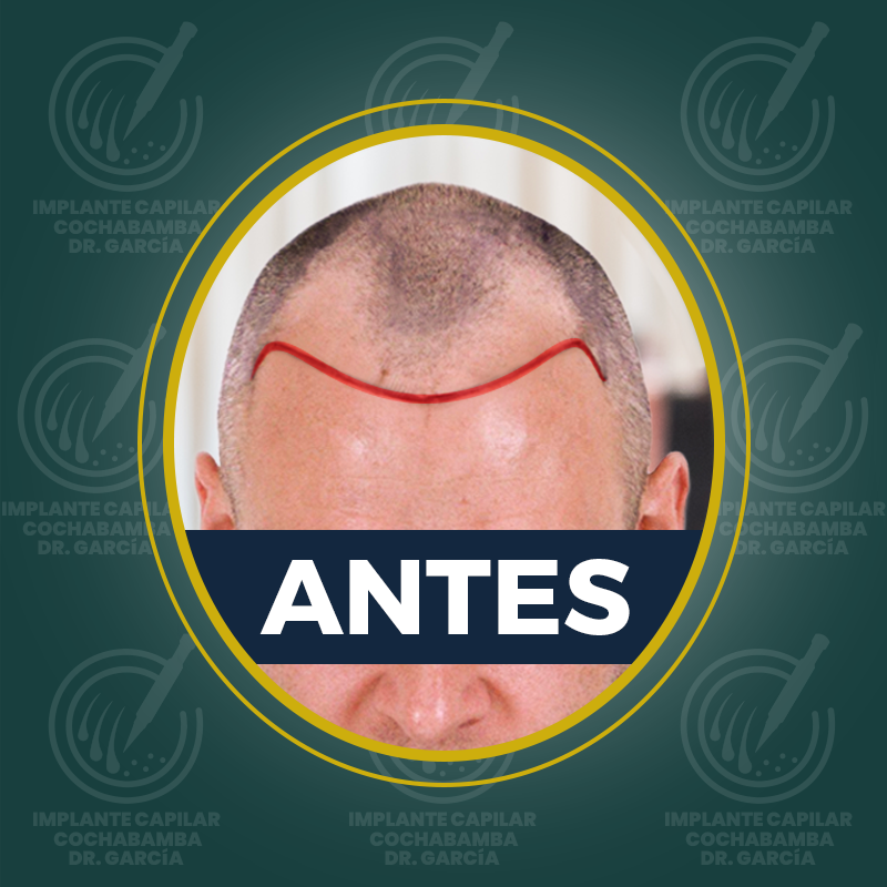 undefined - Antes