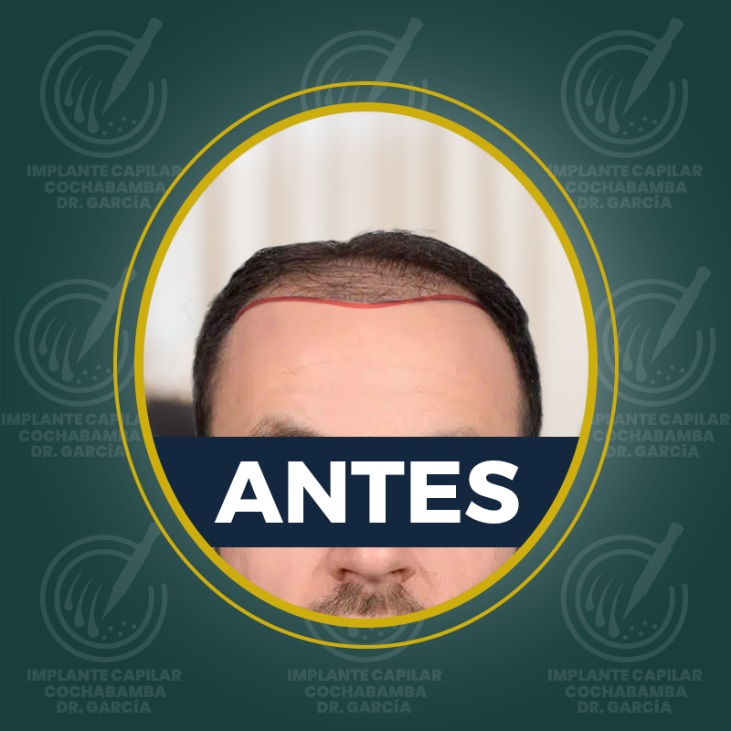 undefined - Antes
