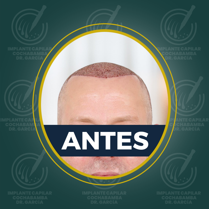 undefined - Antes