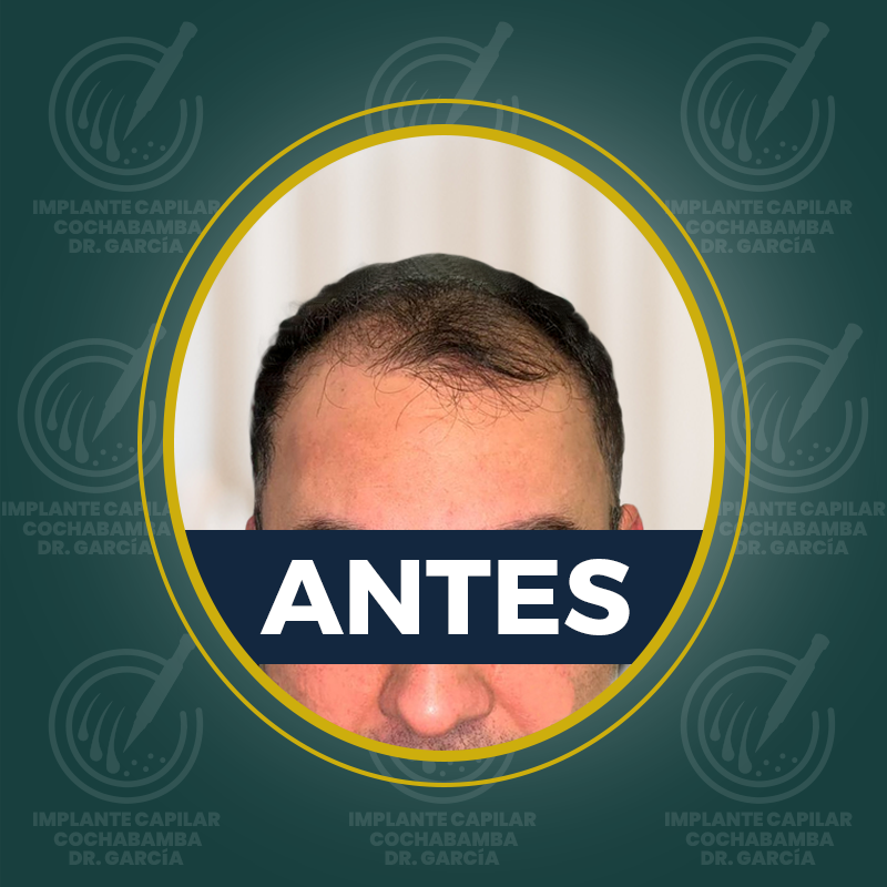 undefined - Antes
