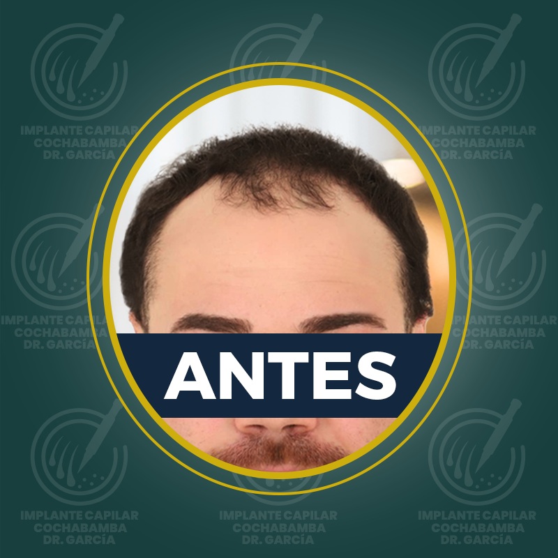 undefined - Antes