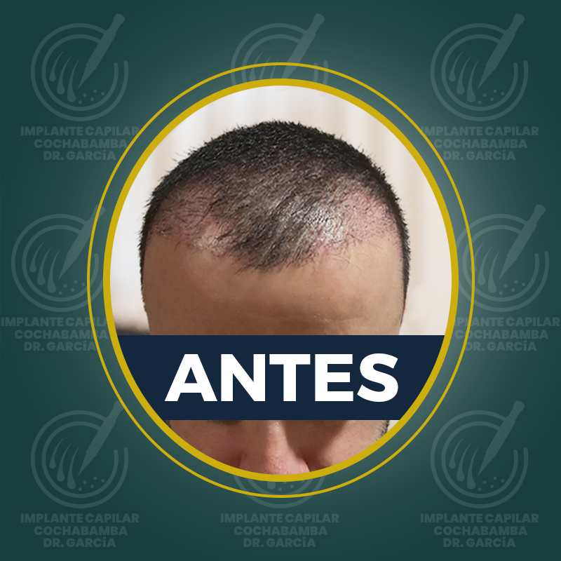 undefined - Antes