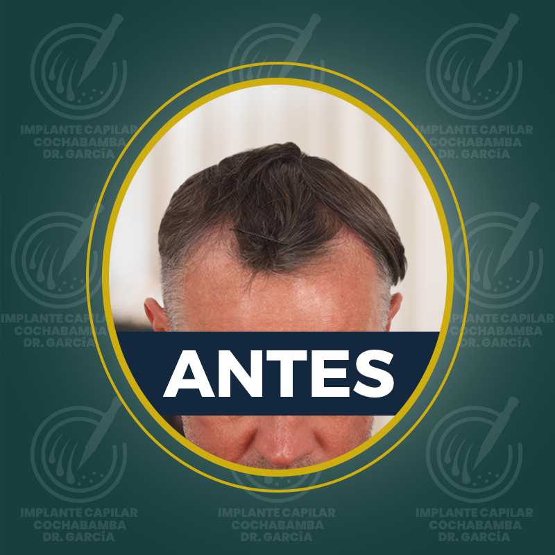 undefined - Antes