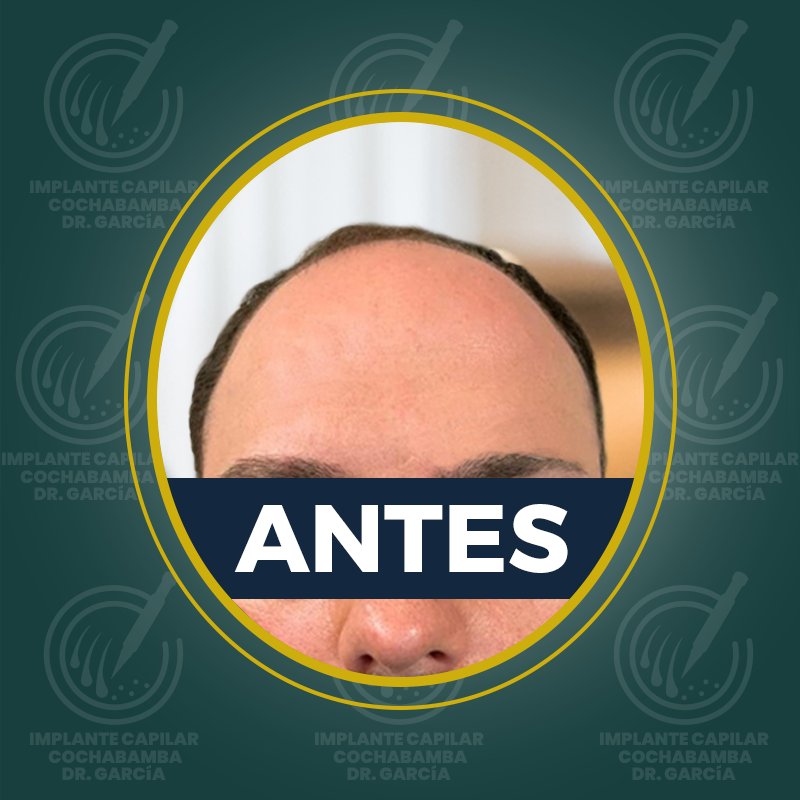 undefined - Antes