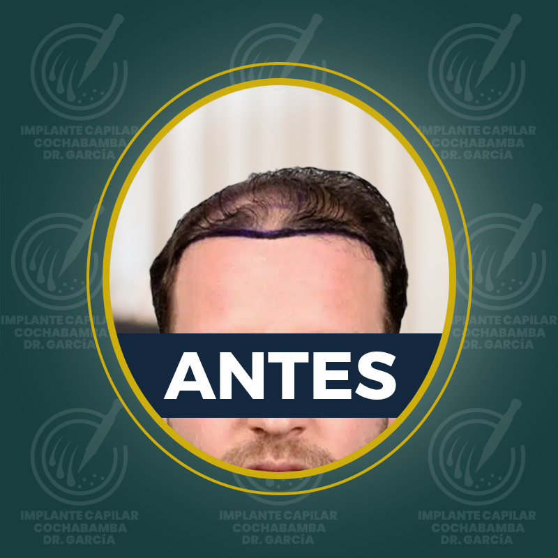 undefined - Antes