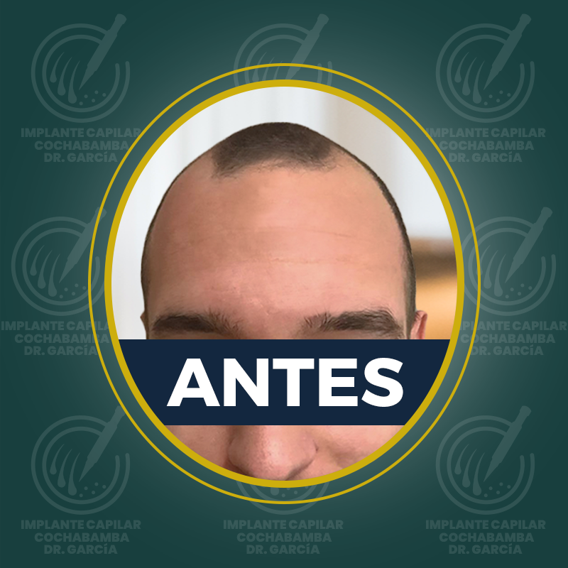 undefined - Antes