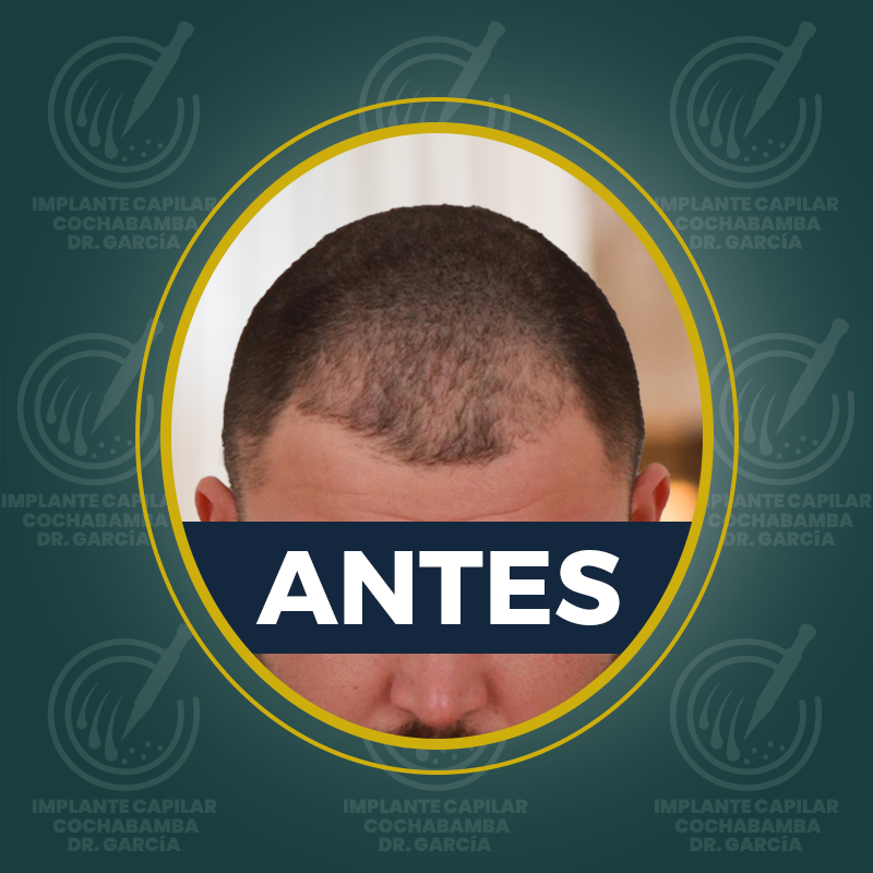 undefined - Antes