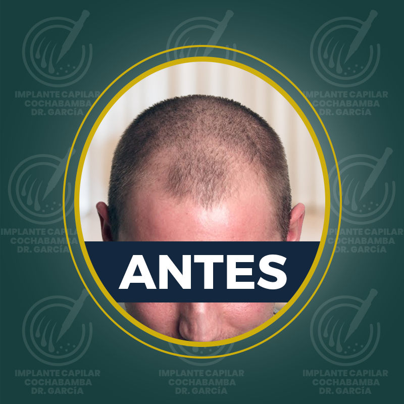 undefined - Antes