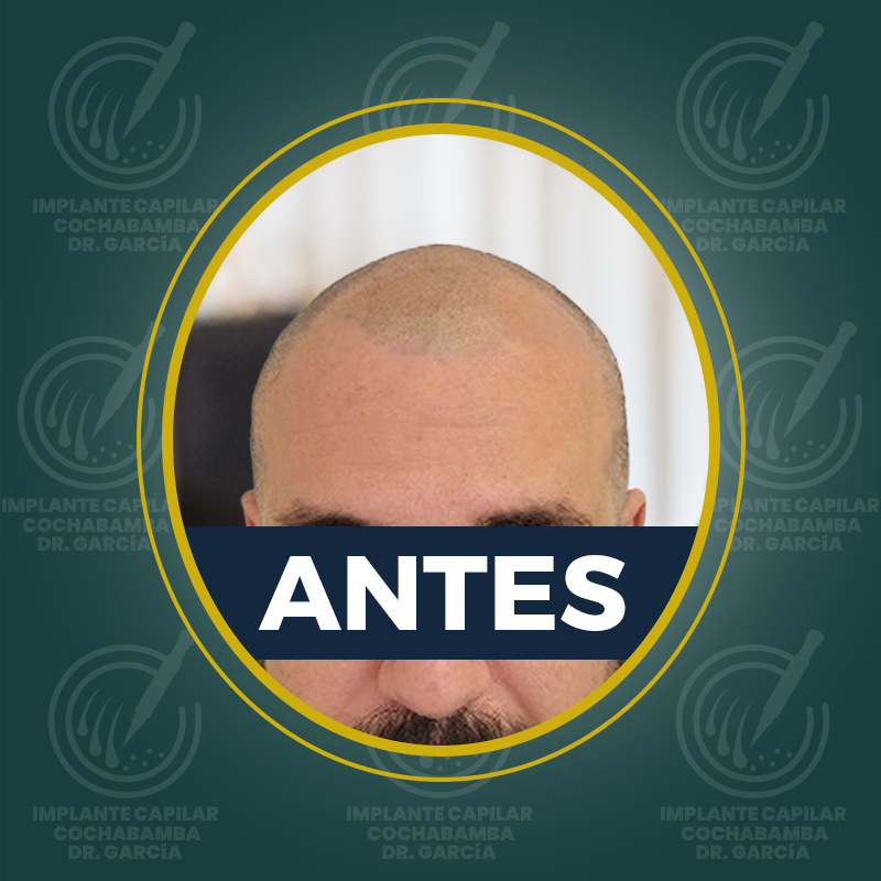 undefined - Antes