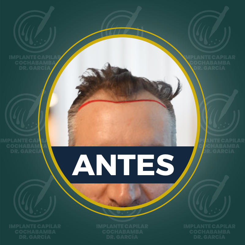 undefined - Antes