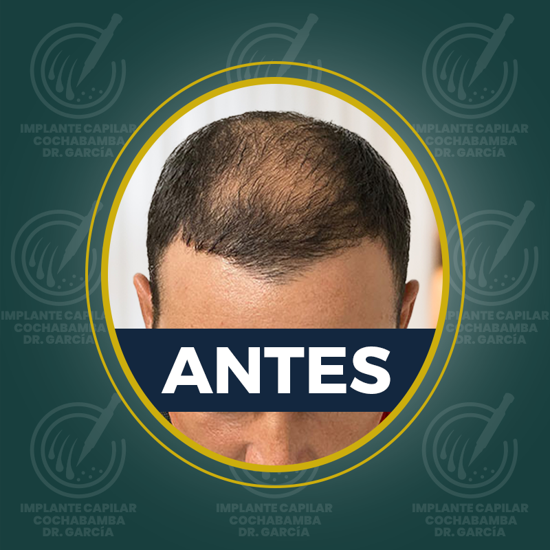undefined - Antes