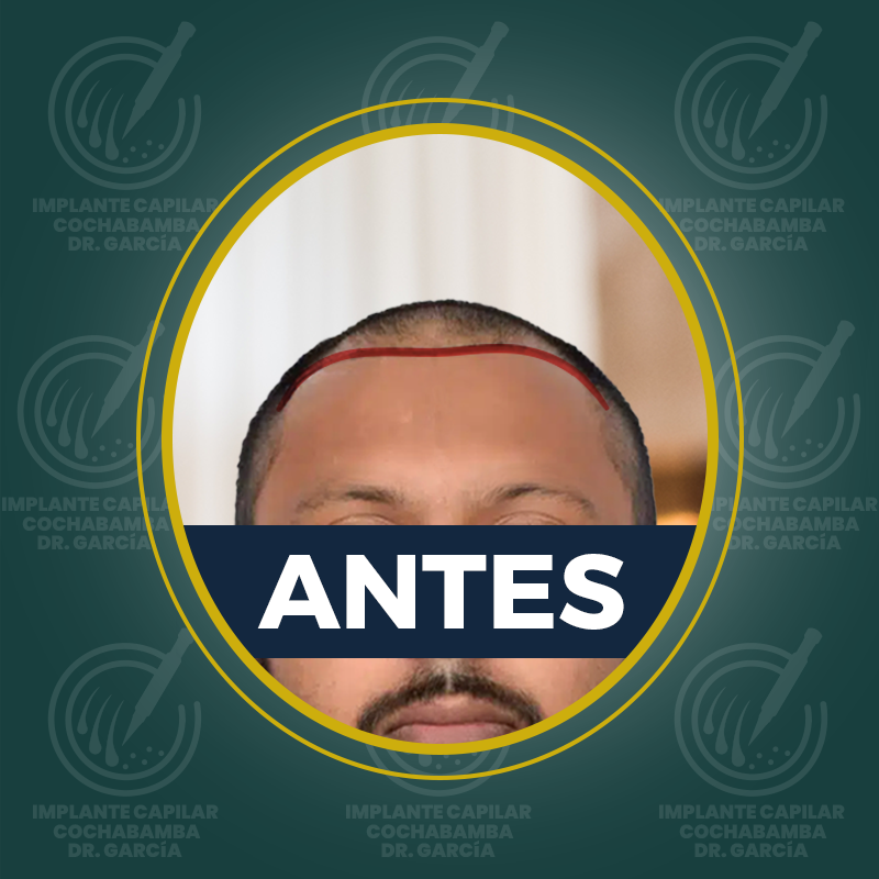 undefined - Antes