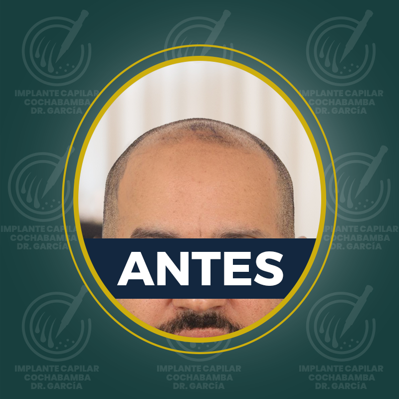 undefined - Antes