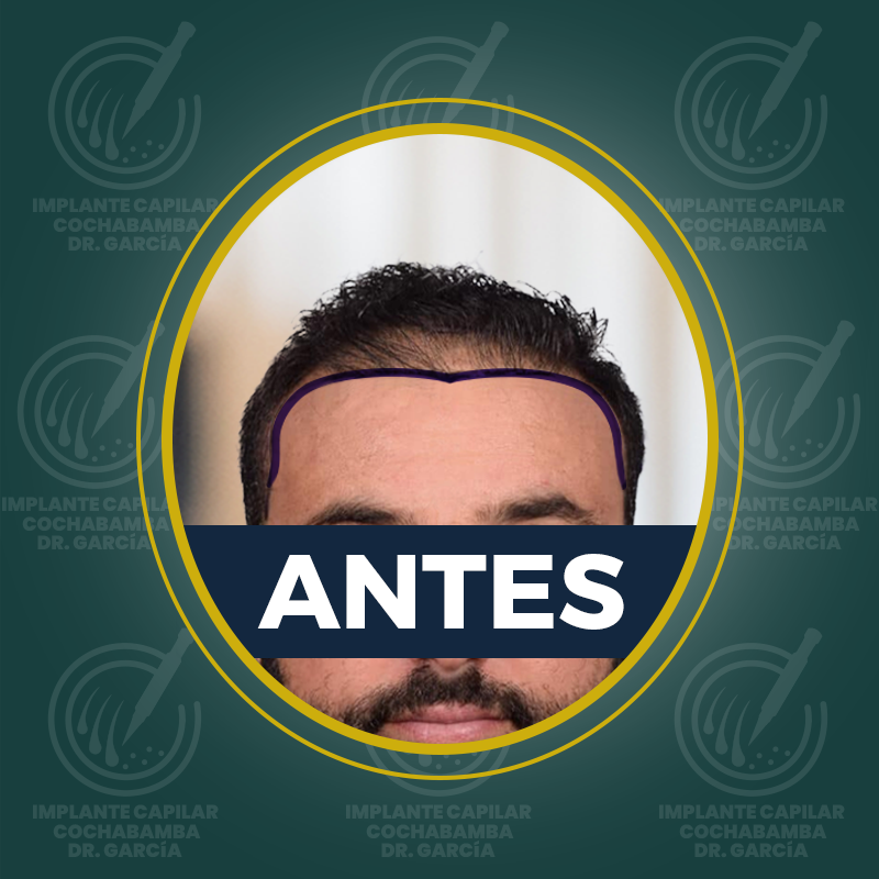 undefined - Antes